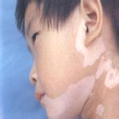 要怎么檢查確診小孩是不是得了白癜風