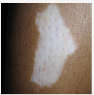 靈壽白癜風醫院診斷白癜風的依據有什么?