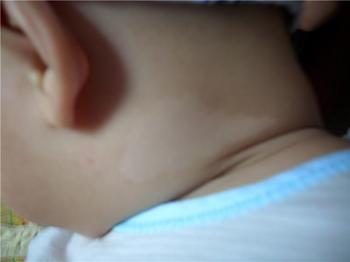 新生兒頸部有個小白點是白癜風嗎