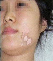 診斷女性白癜風有哪些方法?
