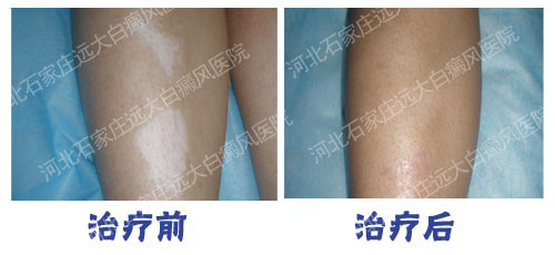 腿部對稱性白斑是白癜風嗎