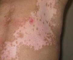 白癜風常規的檢查方法有哪些