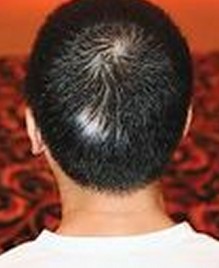 男性頭部如何診斷患上白癜風