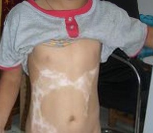 身上有大小不一的白斑會是白癜風嗎