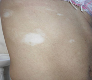 皮膚有點白一定是白癜風嗎