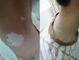 脖子上出現白斑是白癜風嗎