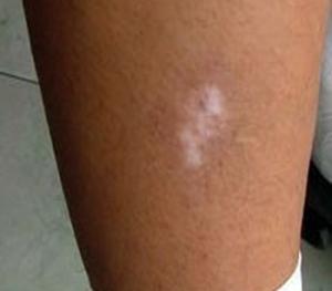 腿上黃豆粒大小的白點是白癜風嗎