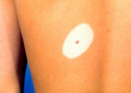 后背長了一個圓形白色斑是怎么回事