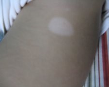 wood燈檢查白癜風是什么