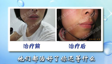 男孩嘴角長了一點白斑是什么