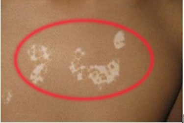 白斑病和白癜風是一種病嗎