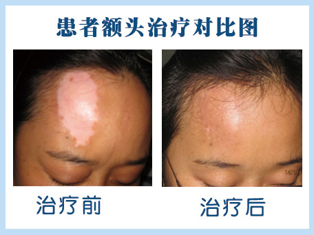 白癜風(fēng)檢查