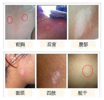后背出現(xiàn)圓形不規(guī)則白斑可能是白癜風(fēng)嗎