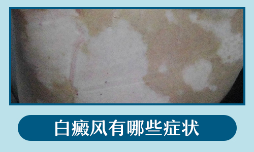 暈痣和白癜風的差異在哪里