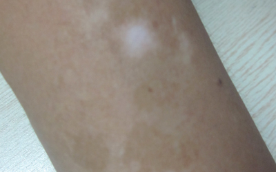 三月前右臂出現白斑是什么病