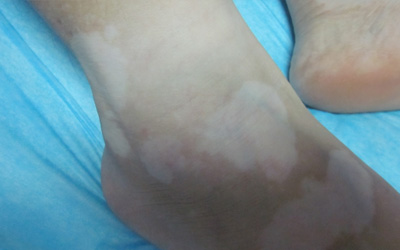 腳上有白色的小圓點(diǎn)是什么