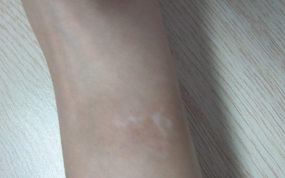 手臂上長一塊白斑是白癜風嗎