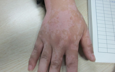 手上長白斑白點是白癜風嗎