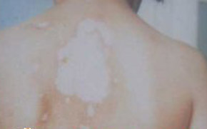 背部白癜風(fēng)有什么癥狀呢?