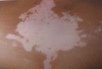 <a href=http://www.xvxgx.cn/ target=_blank class=infotextkey>石家莊白癜風(fēng)醫(yī)院</a>白癜風(fēng)臨床表現(xiàn)