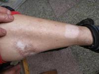 白癜風擦了藥膏會出現紅腫癥狀嗎?