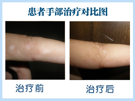 <a href=http://www.xvxgx.cn/ target=_blank class=infotextkey>石家莊白癜風醫院</a>白癜風好轉的跡象