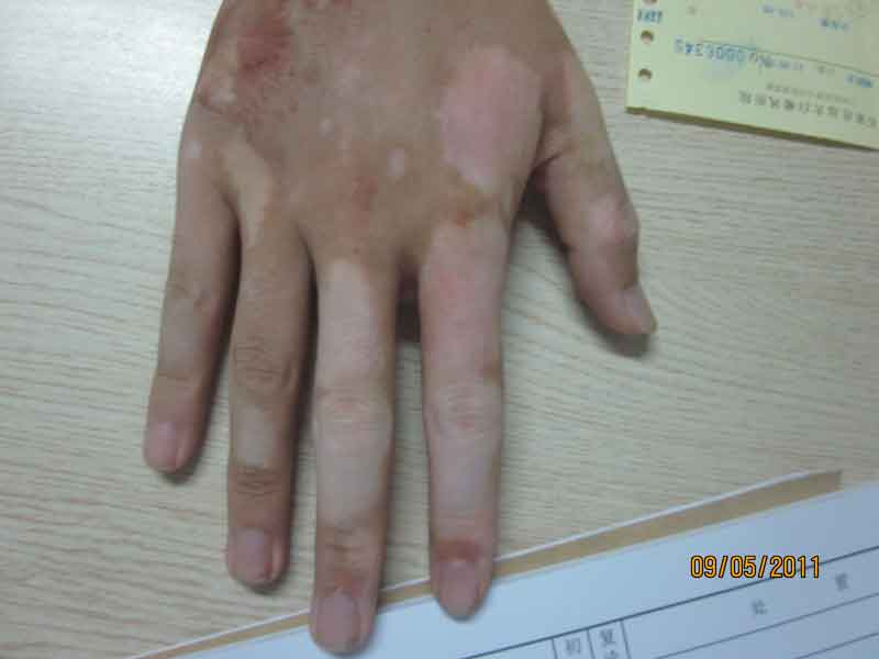 白癜風初期是怎么樣的?