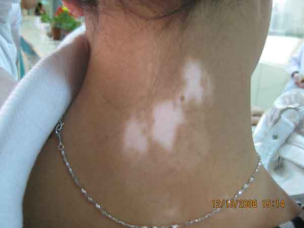 初期白癜風(fēng)對(duì)皮膚的損害有哪些表現(xiàn)?