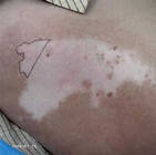 白癜風患者用藥后患處發紅發癢正常嗎?