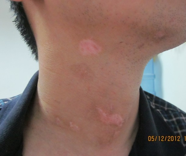 白癜風擦了藥膏會出現紅腫癥狀嗎?