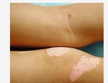 白斑其實(shí)就是白癜風(fēng)癥狀的表現(xiàn)嗎