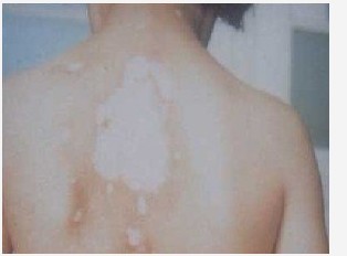 哪些癥狀表明白癜風的癥狀加重了