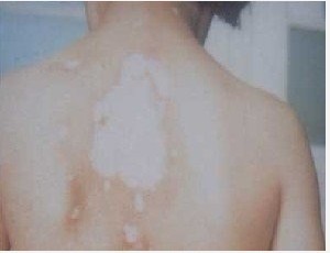 曬傷后的皮膚白斑怎么跟白癜風區分?