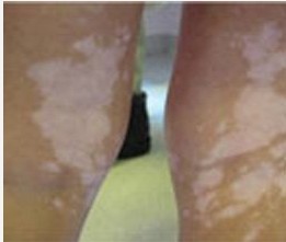 腿部白癜風(fēng)白斑處結(jié)皮是怎么回事?