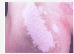 白癜風(fēng)白斑用uvb照射后會(huì)發(fā)紅發(fā)癢嗎