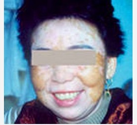 老年人臉上發(fā)白的斑塊是不是白癜風(fēng)?