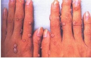 白癜風(fēng)用308照光治療后起水皰是過敏嗎?