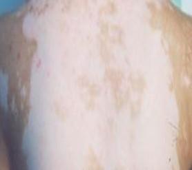 白癜風(fēng)患者身上各個部位都有白斑是泛發(fā)型嗎