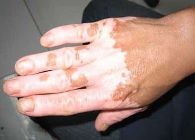 患有白癜風(fēng)身體方面會出現(xiàn)哪些癥狀?