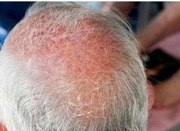 為什么有的白癜風患者出現患處毛發變白現象?