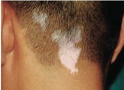 為什么有的白癜風患者出現患處毛發變白現象?