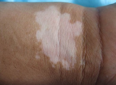 白癜風白斑處先變黑后變白是怎么了?