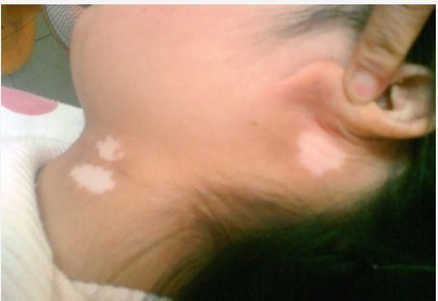 小兒白癜風的圖片是什么樣的?