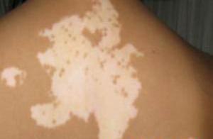 白癜風(fēng)有哪些明顯的癥狀表現(xiàn)