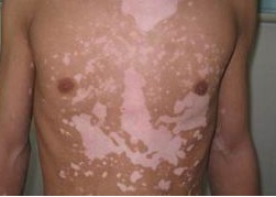 胸部白癜風初期是什么癥狀?