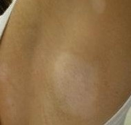 慢性白癜風(fēng)的癥狀有哪些