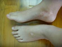 白癜風早期癥狀的圖片是什么樣的