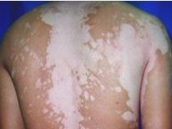 白癜風的常見癥狀表現是什么