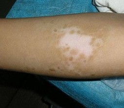 胳膊上白斑是不是白癜風癥狀