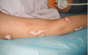 得了白癜風(fēng)有什么癥狀